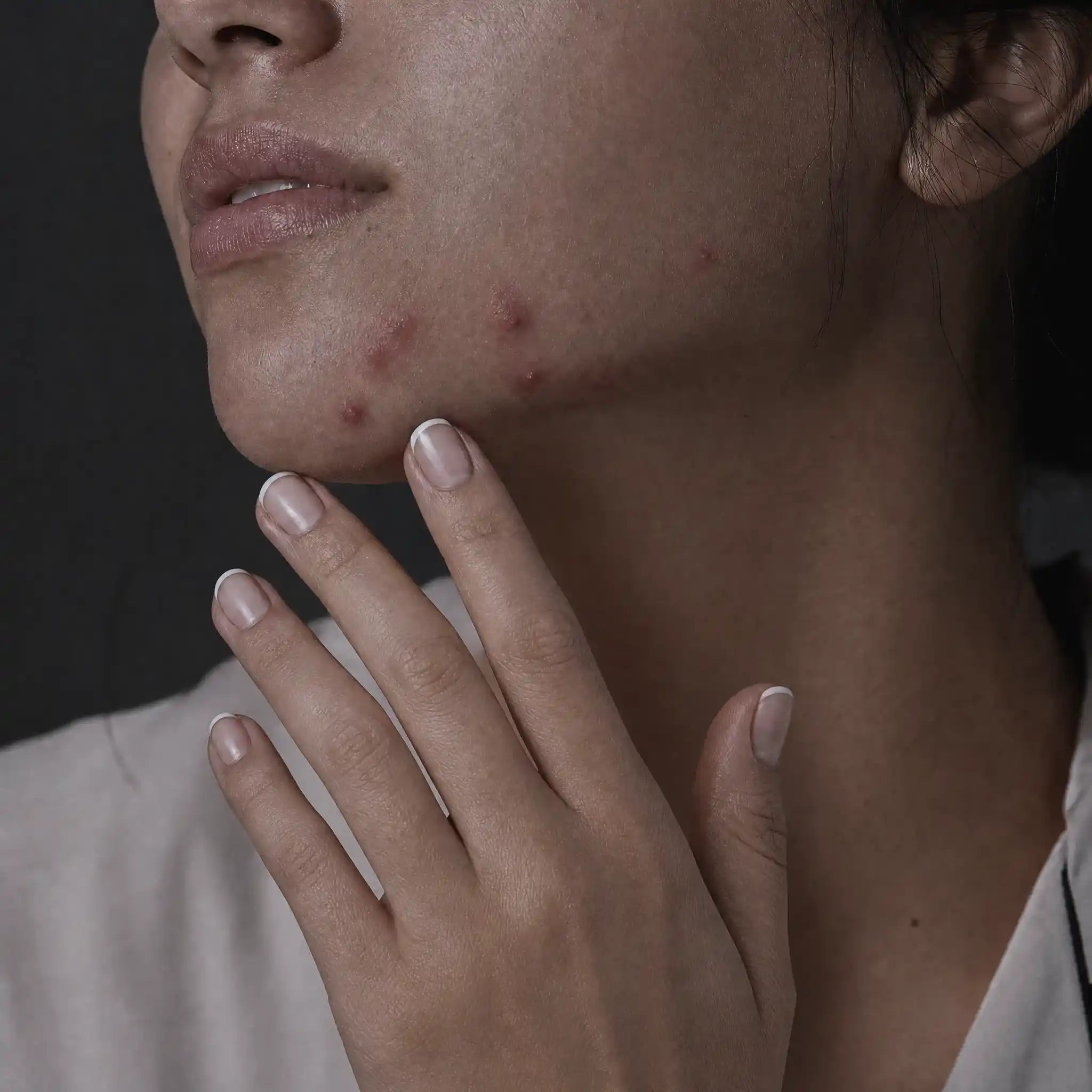 Acné hormonal